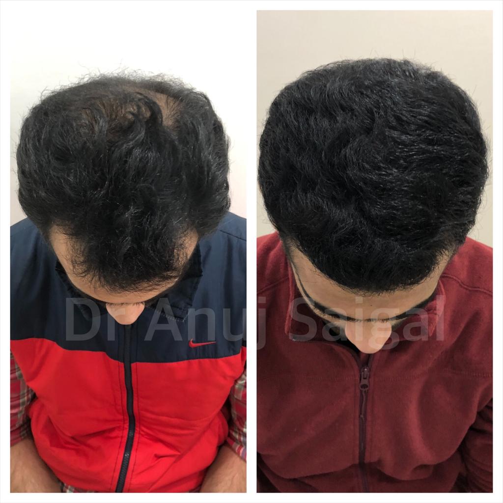 Best hair transplant doctor in delhi